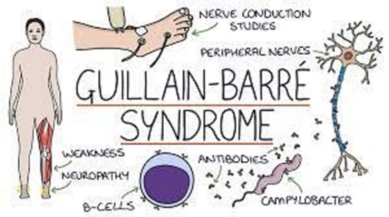 Guillain-Barré syndrome